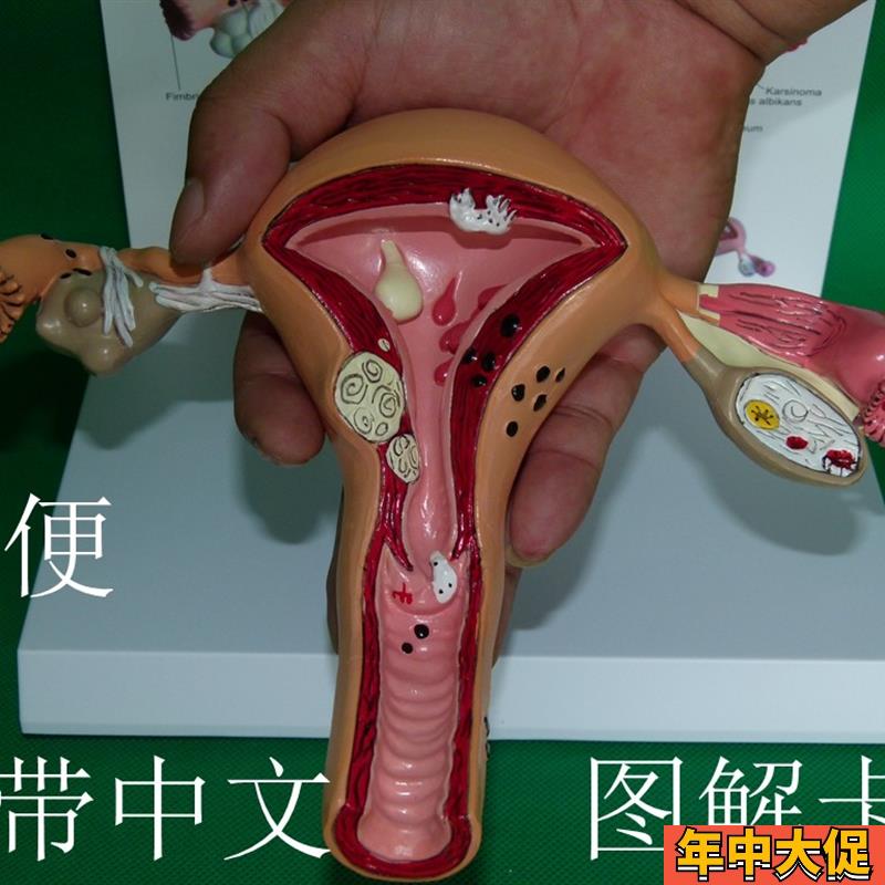 子宫卵巢病理病变模型 生殖科 医药礼品模型 女性子宫阴道模型