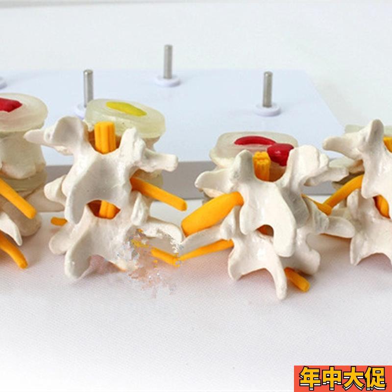 4阶段病态腰椎比较模型人体四个时期病变腰部脊柱脊椎模具标本