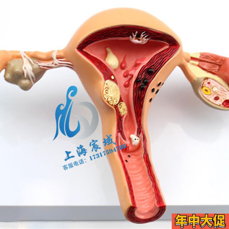 子宫卵巢病理病变模型 生殖科 女性内外生殖器官模具教学病变