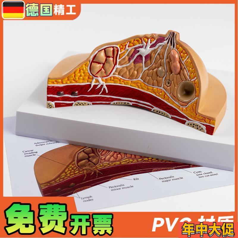 德国】PNT-0741 乳房病理模型女性乳房病理医学教学模型妇科教学