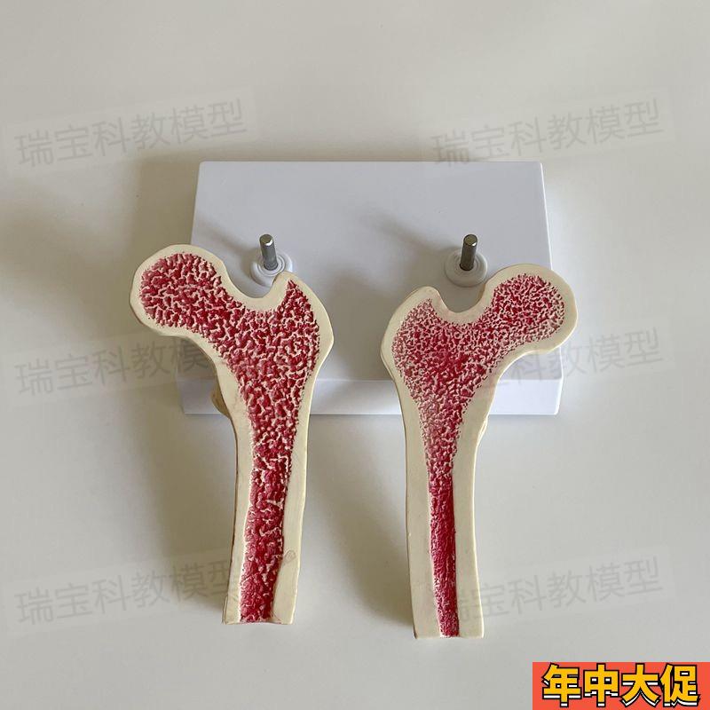 骨质疏松模型股骨头骨髓密度变化骨科医药促销年龄段脊椎病理医患