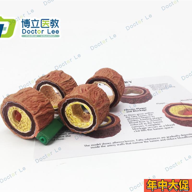 动脉粥样化模型 血栓病变模型 心血管模型 医学模型 教学模型