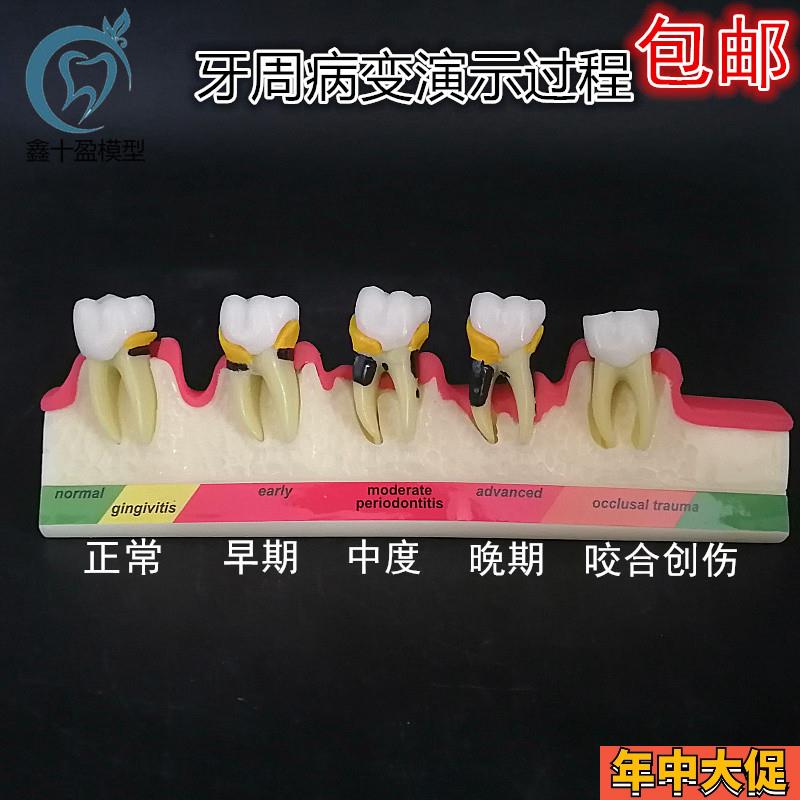 牙齿牙科牙模牙周分类模型牙周并变重的过程牙科医患沟通展示模型
