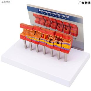 心脑血管堵塞动支脉粥样硬化血r栓血液浓度脂肪病理教学用模型道