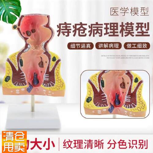 大号人体直肠模型结肠病理直肠痔疮直肠常见病模型直W肠和肛管模