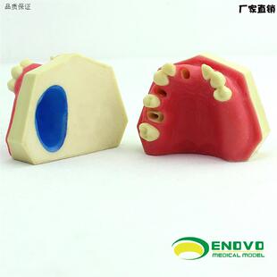 ENOVO颐诺口腔种植上颌骨上颌窦牙列缺失种植体牙医牙h科牙齿模型
