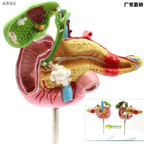 ENOVO颐诺j医学胰腺十二指肠胆囊病理模型胆结石外科消化系统模型