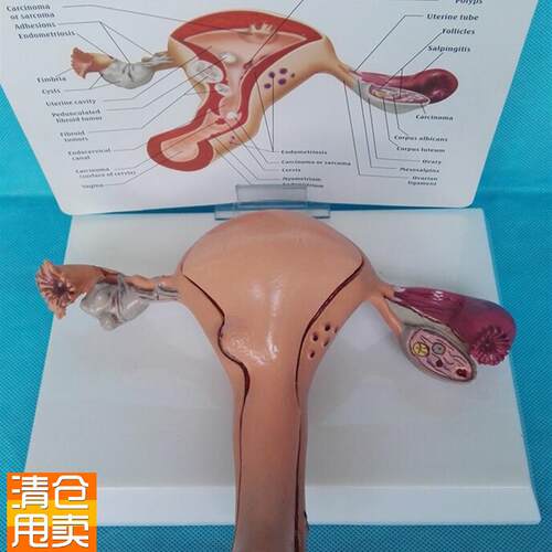 女性病理子宫模型妇产子宫结E构解剖仿真病态子宫讲解