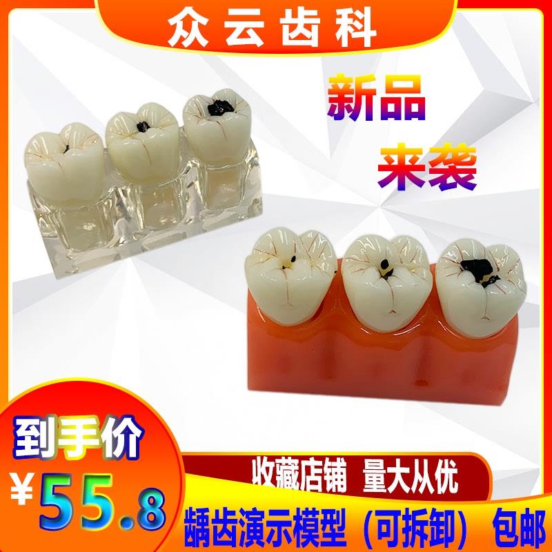 牙科模型四倍龋齿演变模型蛀牙演示医H患沟通龋齿发展病理分解模
