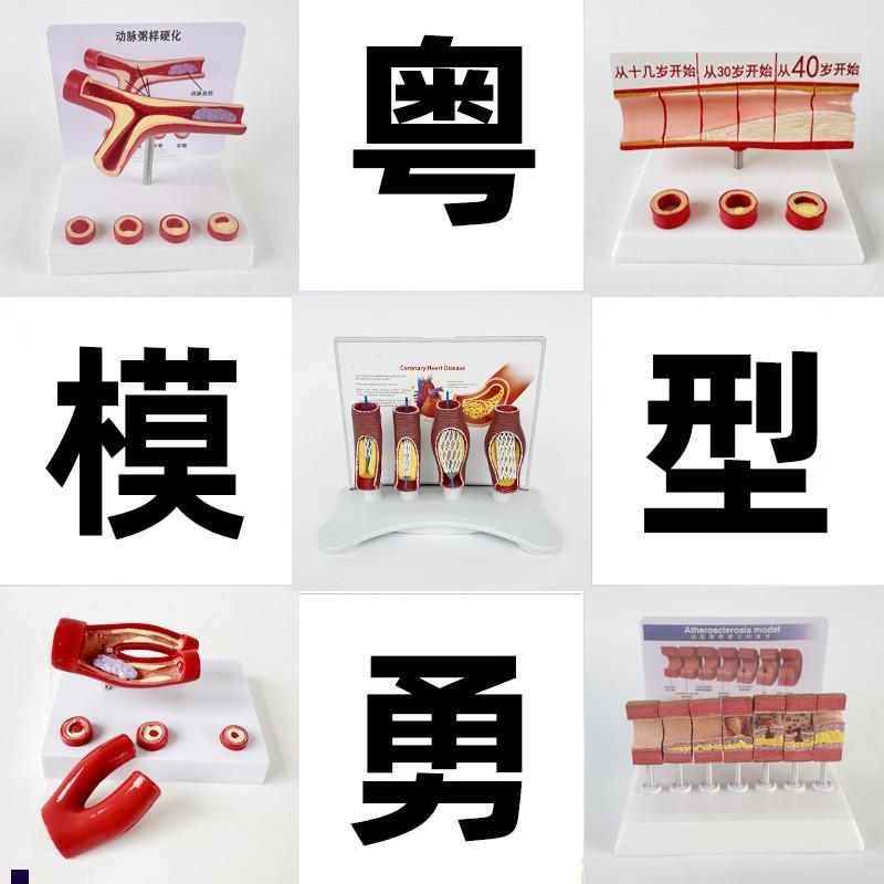 动态血管粘稠堵塞模型q动支脉粥样硬化心血管支架放大病理教学模