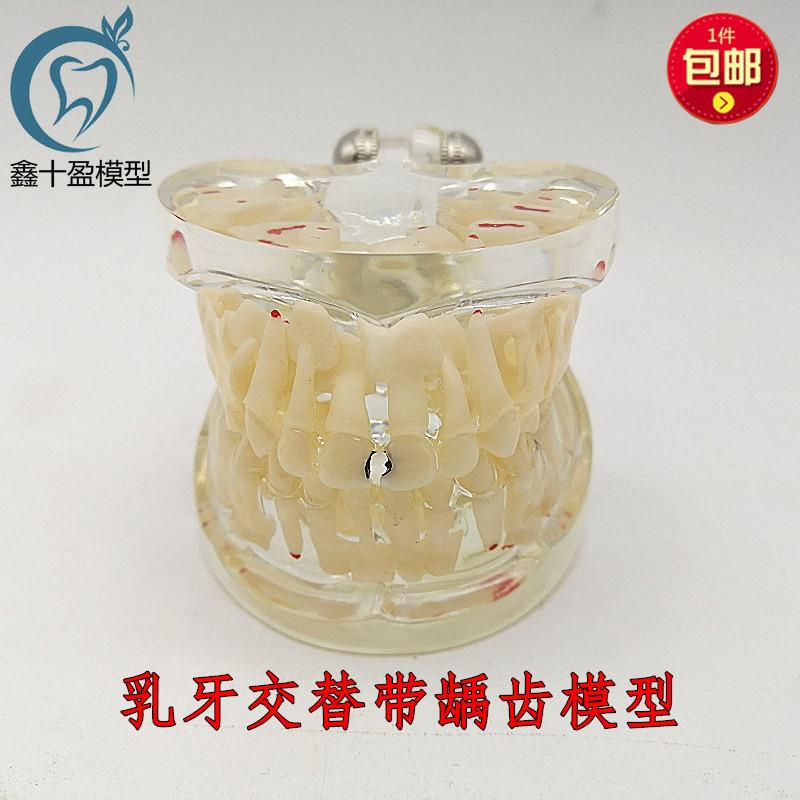 乳牙模型 恒牙g模型 乳牙龋齿牙模型教学 窝沟封闭口腔齿科材料C1