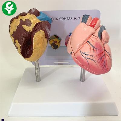 健康人与a吸烟人的心脏比较演示模型心脏模型病理心脏解剖模型