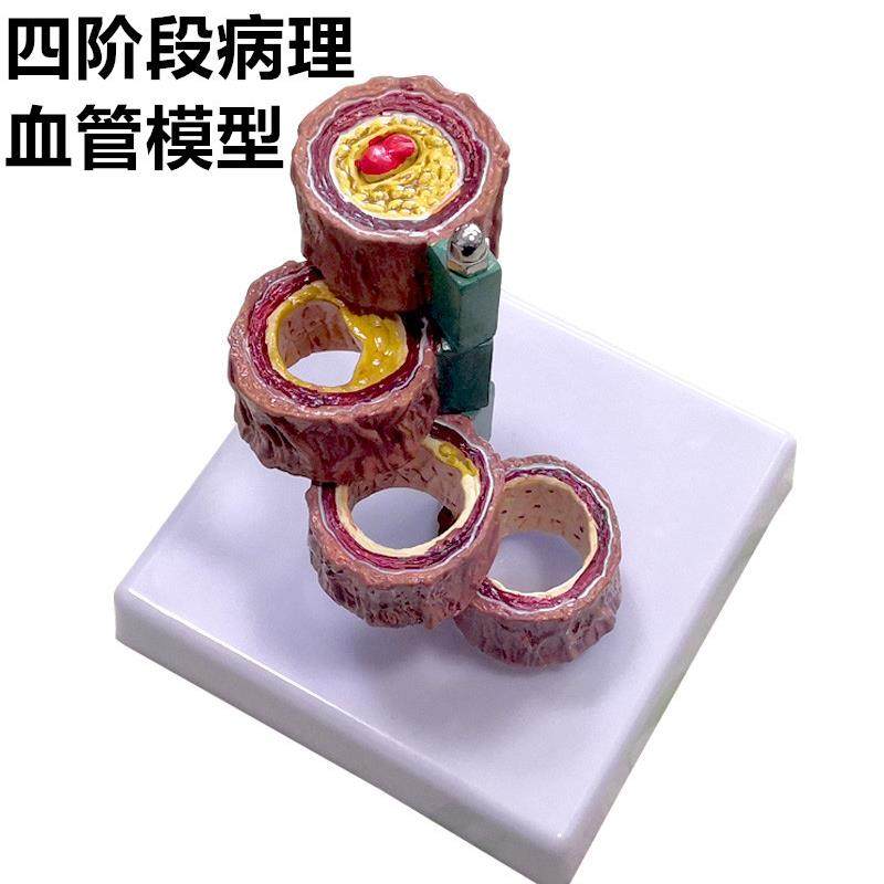 血管模型 血栓人体支脉/粥样/硬化 心血管动脉模型心内.科教学通