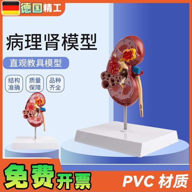 德国】病理肾模型 肾脏模型x人体内脏模型自然大肾解剖附肾上腺模