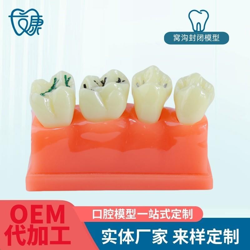 透明窝沟封闭g模型牙科口腔教学牙模种植修复病理模型牙齿模型厂