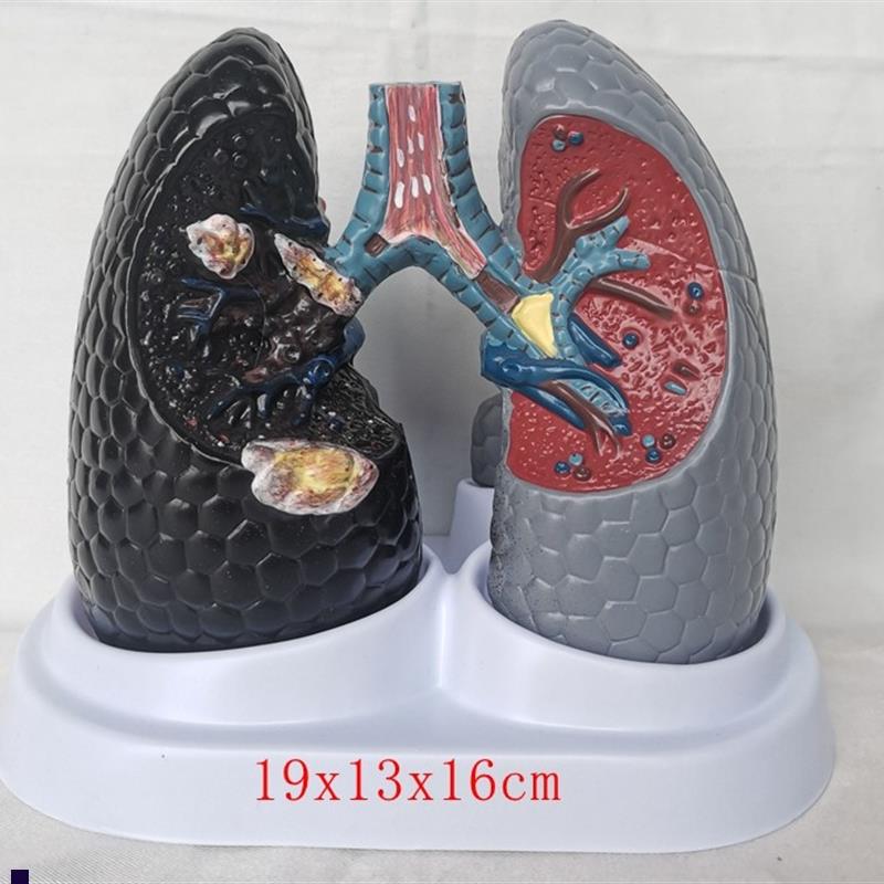 人体吸烟癌变肺k模型健康肺模型人类内脏吸烟肺与健康肺模型