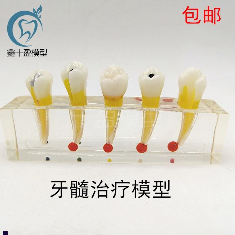 牙科口腔牙齿模型牙l髓修复模型前磨牙牙体蛀牙根管龋坏M4007-2