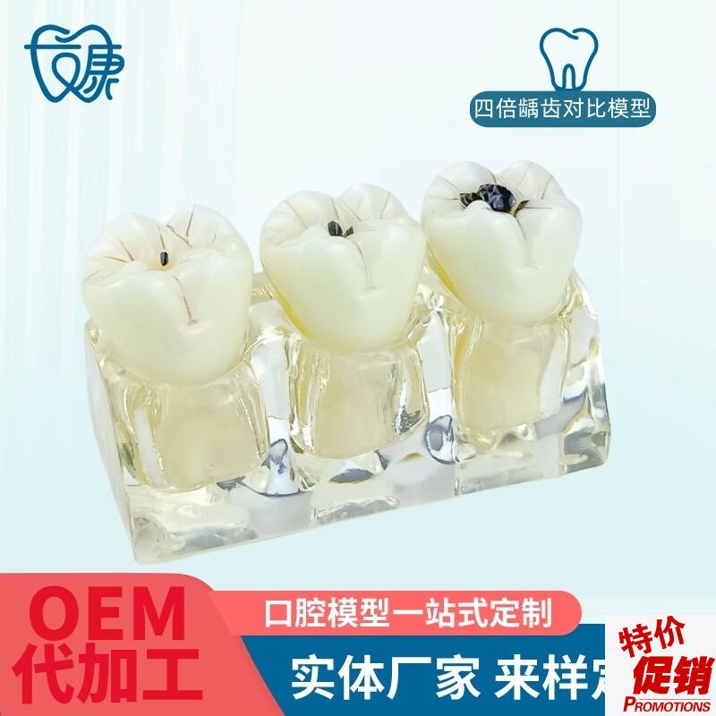 牙模型牙科口腔教学模型u窝沟封闭模型龋齿对比模型龋齿模型