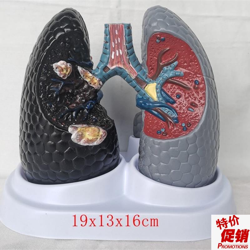 人体吸烟癌变肺模型健康肺模型人类内脏吸烟肺X与健康肺模型