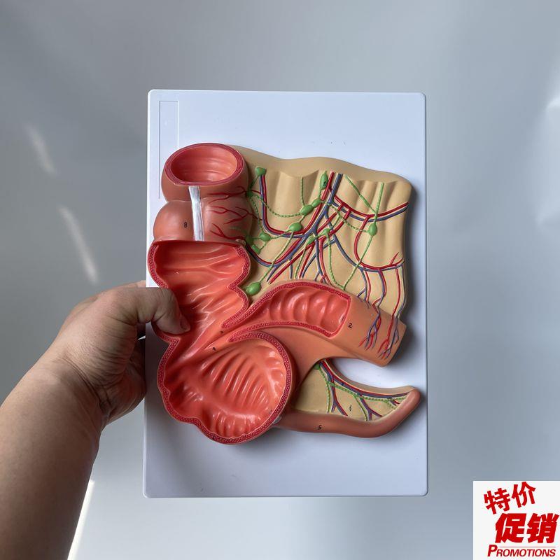 盲肠阑尾肠系膜淋巴血管回v盲瓣消化道结肠直肠肛管肛肠医药促销