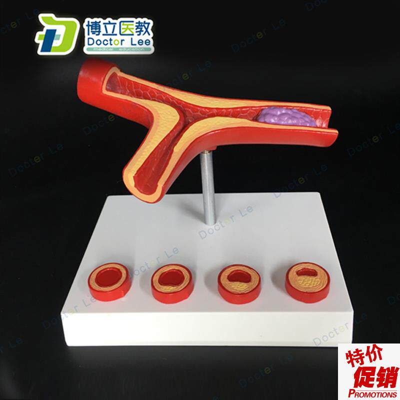 血管堵4塞血液j浓度脂肪病理血液血管粥样血管病理解剖模型