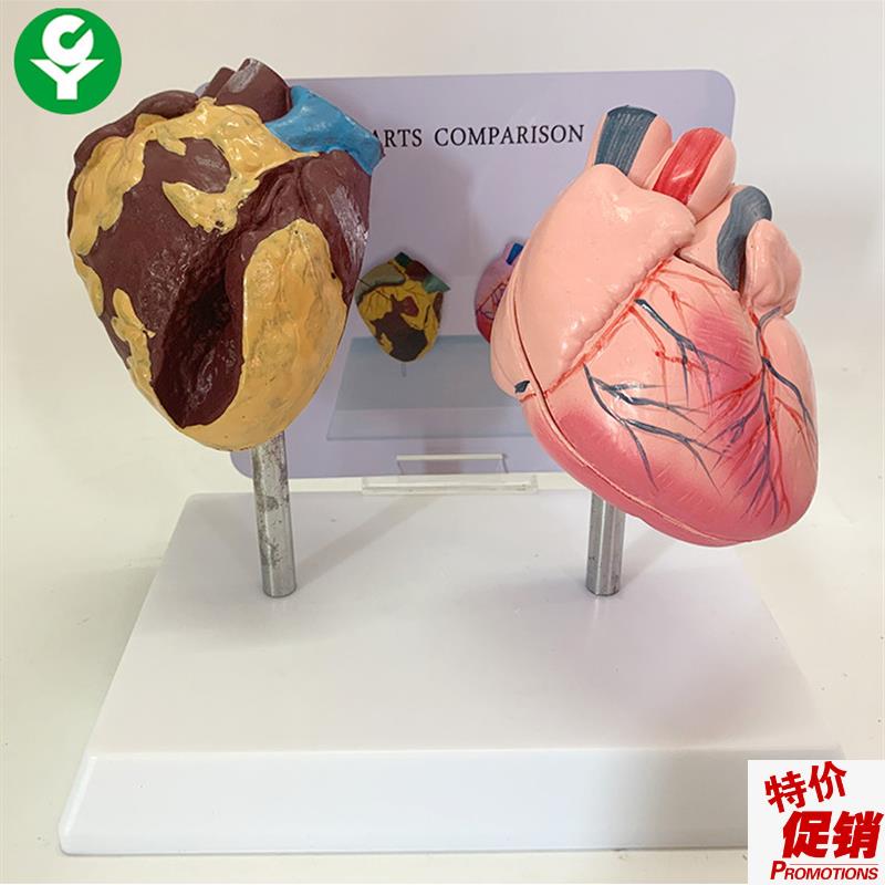 健康人与吸烟人的心脏比t较演示模型心脏模型病理心脏解剖模型