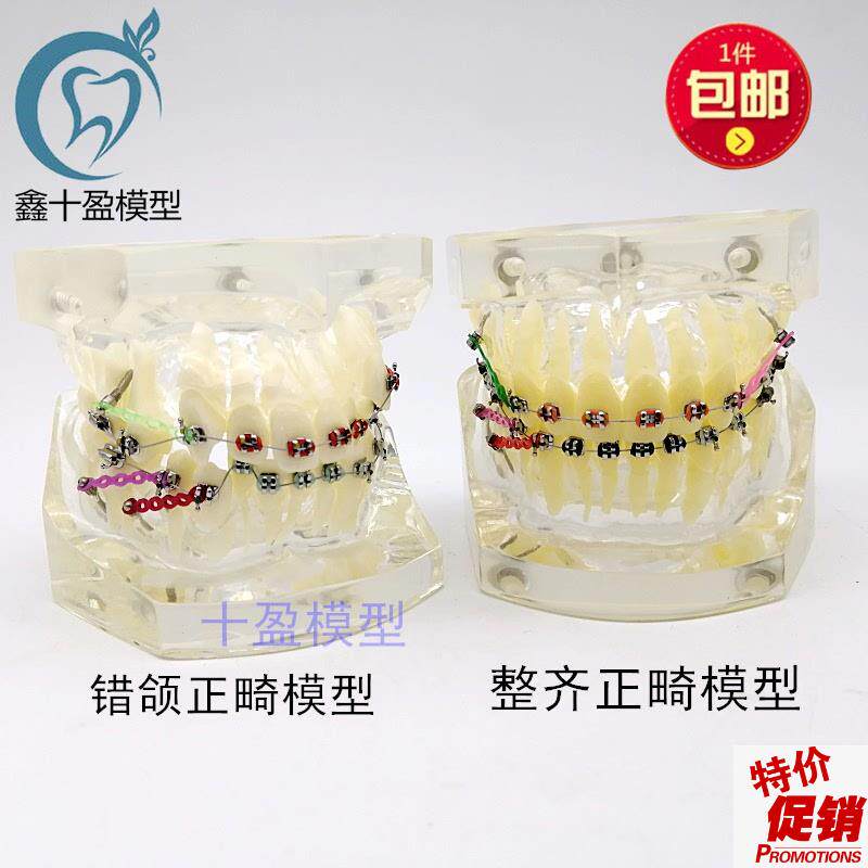 牙科正畸模型透明错颌矫正展示模型结扎丝托槽正U畸带支抗钉牙列