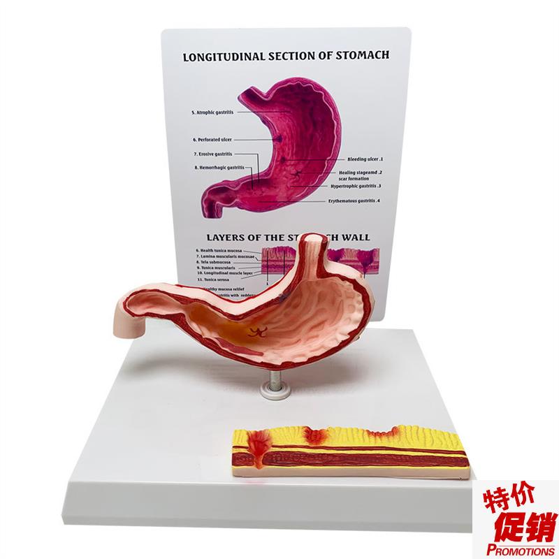 胃解剖模型胃腹l腔病态解剖模型结构人体教学教具人体解剖