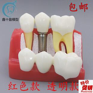 牙科口腔教学4倍种植解说模型牙冠可拆卸替换种植V钉展示模型包邮