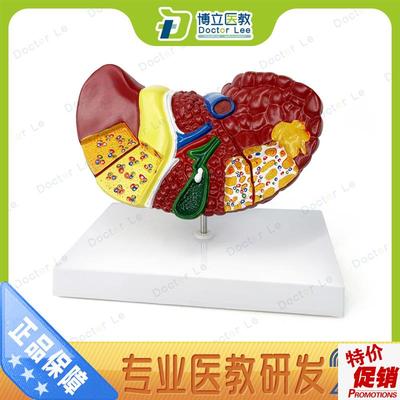 肝脏模型b肝脏病理模型肝解剖模型肝胆胰脾十二指肠消化系统