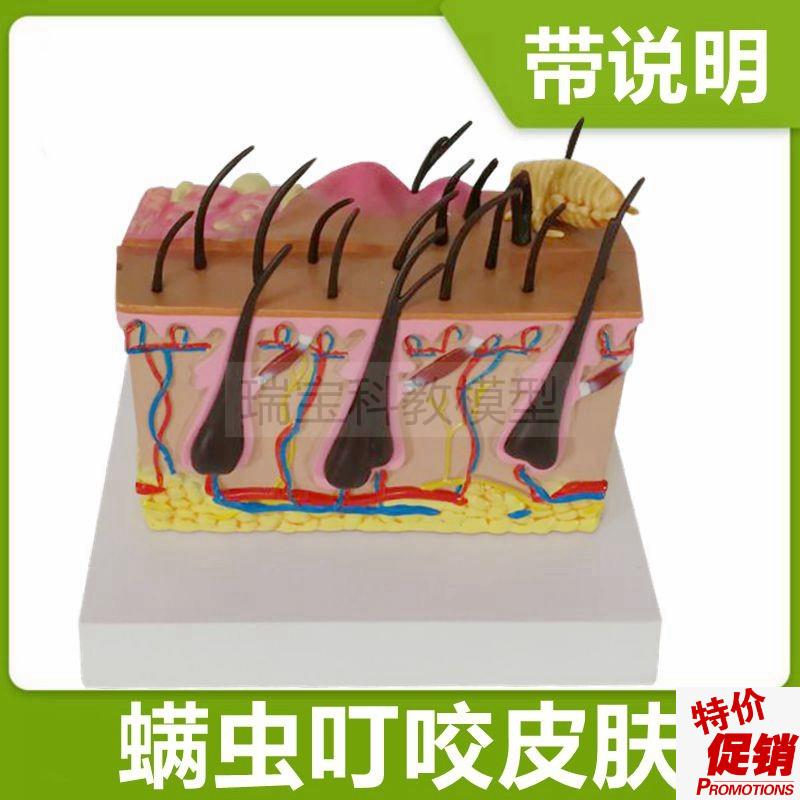 皮肤模型病理蚊虫叮咬q过程皮下病变医美微整形皮肤美容带说明礼