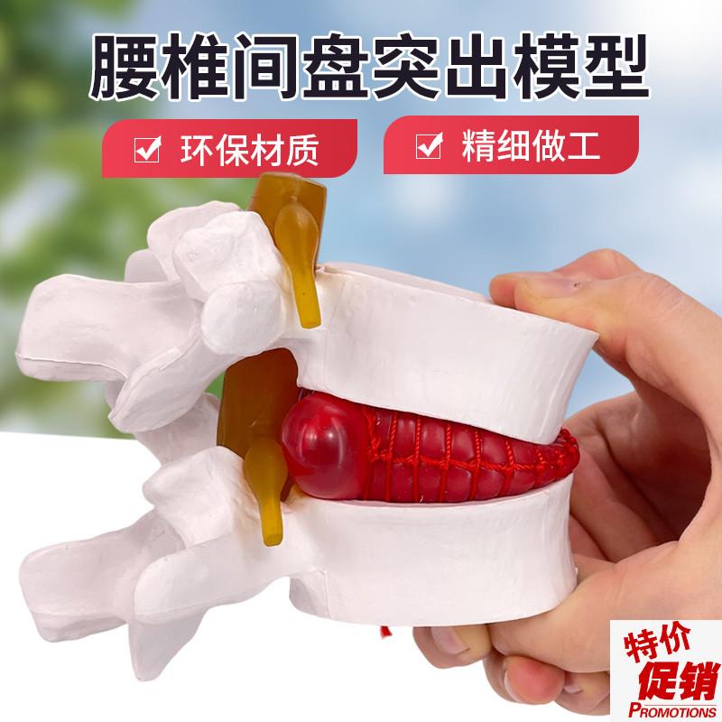 腰椎间盘突出膨出k演示模型人体脊柱脊椎病理演示关节医学教学用