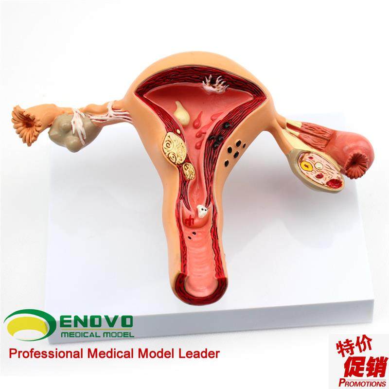 ENOVO颐诺人k体女性子宫卵巢模型子宫疾病生殖科妇产科医患沟通讲,文具电教/文化用品/商务用品,教学标本/模型,淘宝优惠券,粉丝福利购,淘宝优惠卷