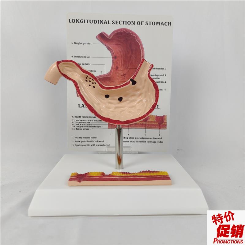 人体病理胃模型胃穿孔胃病胃溃疡病态胃消化科胃冠V状腹腔解剖教