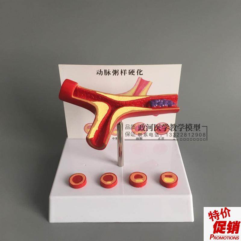 冠状动脉性心血管o动脉硬化模型老年心脏模型血栓形成