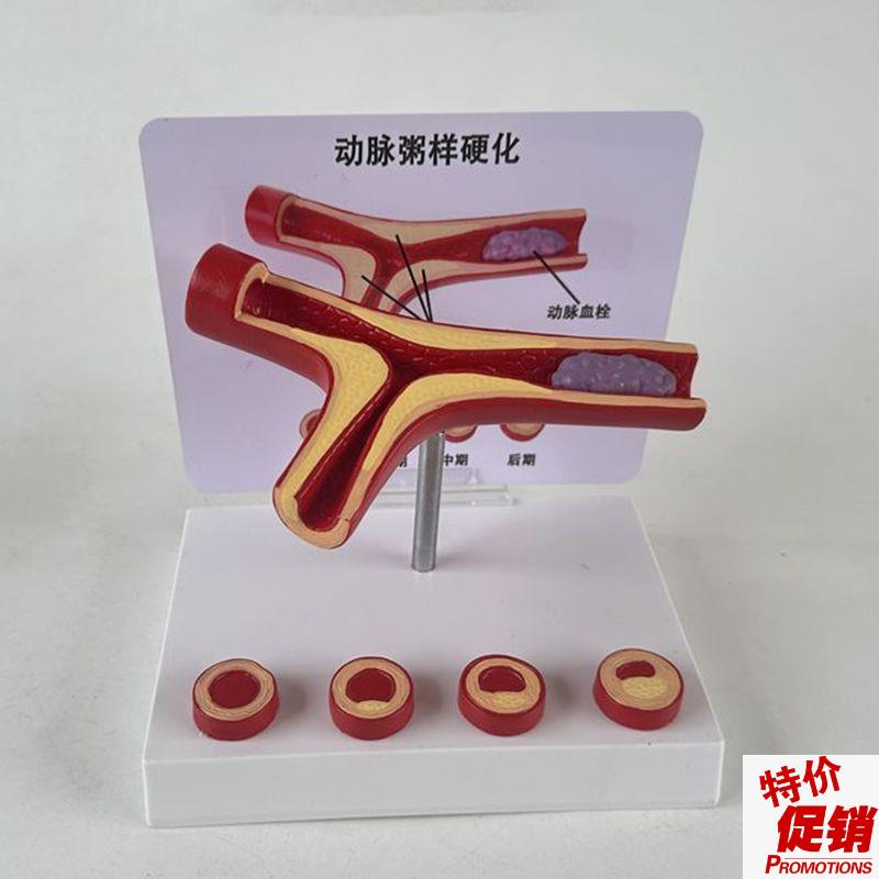 人体血管模型动脉血管结构冠状动脉健康深静脉栓f子临床医患血液