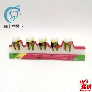 牙科口腔教学演示模型龋齿牙周根管H医患沟通牙周分类模型M8
