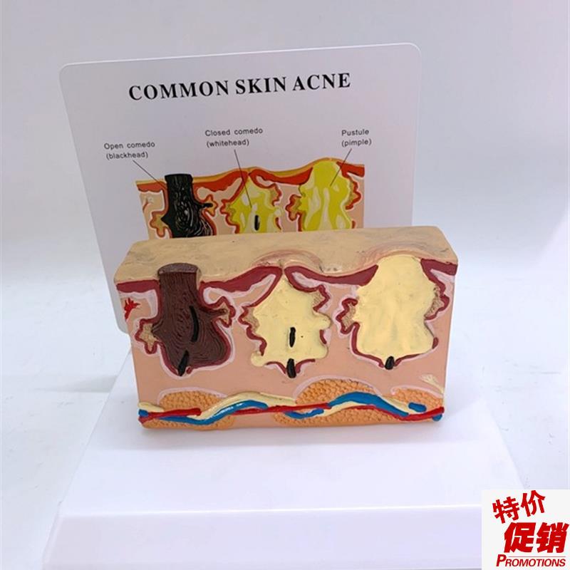 人体皮肤解c剖模型病变皮囊病理演示毛发油脂生长过程酒糟皮肤放