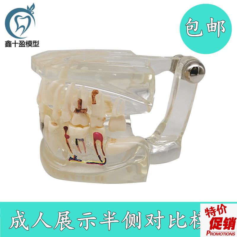 齿科展示口e腔半侧病理水晶透明成人病理牙科诊所教学模型C11包邮