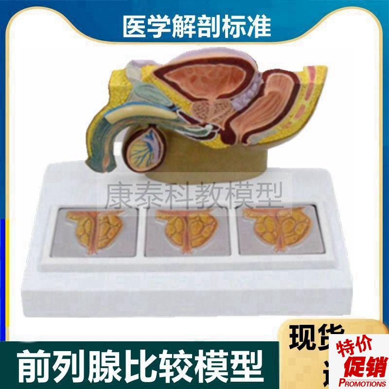 前列腺模型男f性生殖病理肥增大中老人泌尿道临床医用教学医药礼
