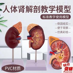 人体肾模型肾解剖自然大人体肾脏模型K肾脏演示病变肾内脏模型