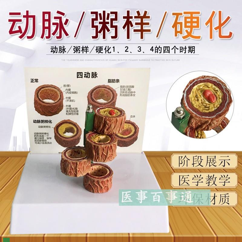 动脉11化模型带血栓模型血管模型形K成过程模型人体粥样化