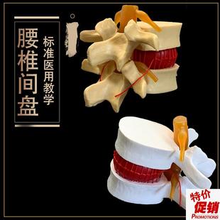 医用人体腰椎g间盘突出演示模型腰椎模型脊柱模型脊椎模型骨科