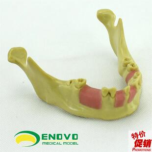 口腔种植齿科培j训实训操作模型仿真下颌骨人工种植缺失牙训练模