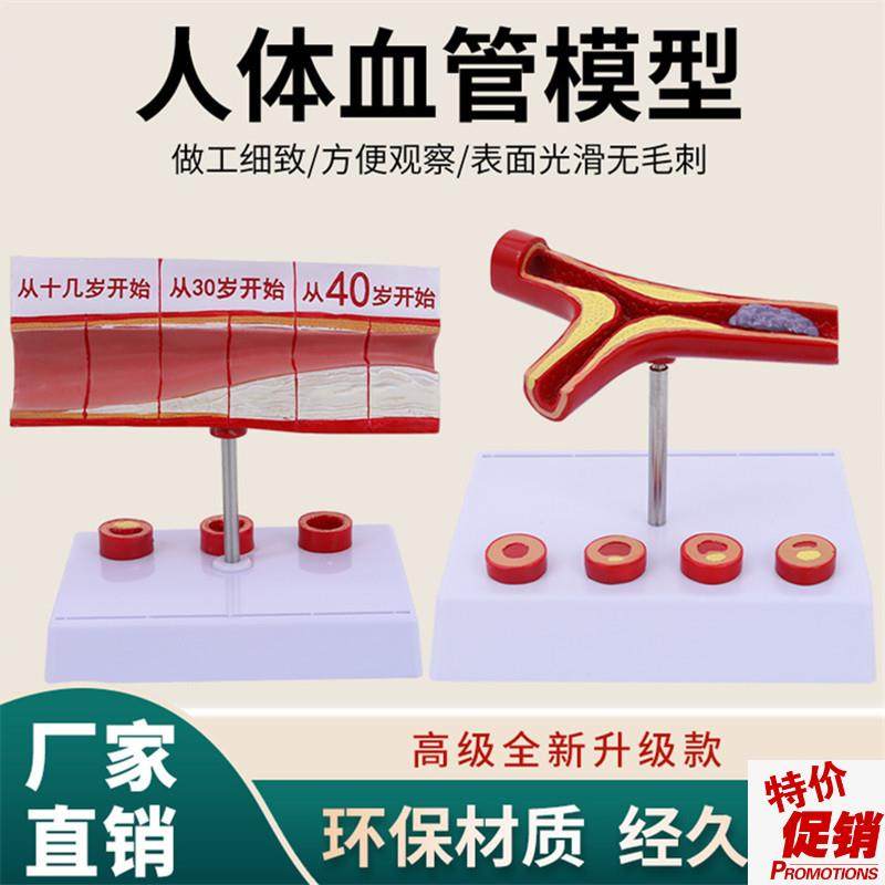动脉性心血管冠状模型硬化动脉模E型老年心脏模型形成血栓模型