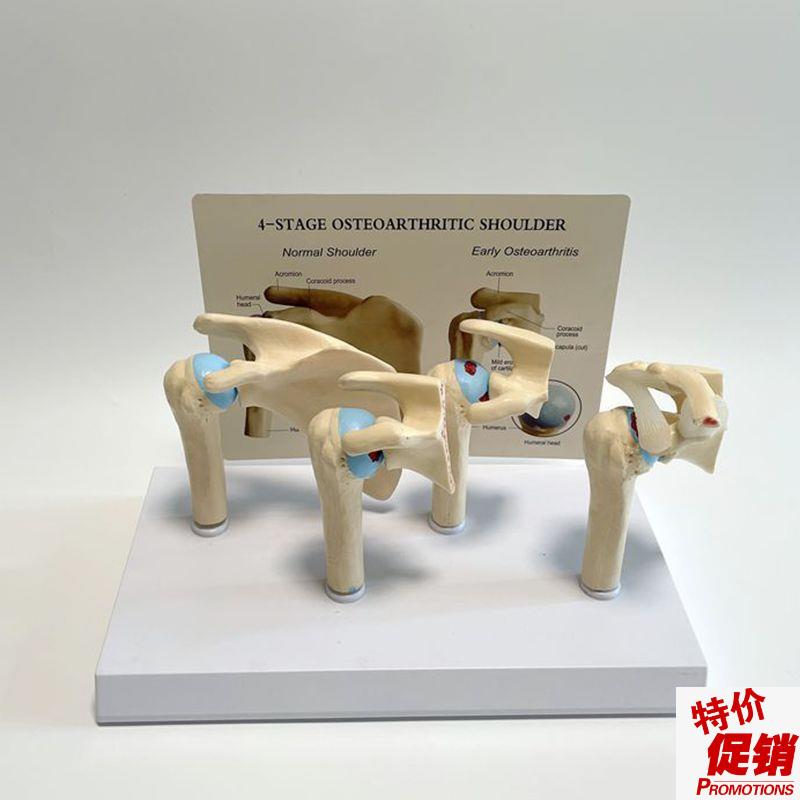 肩关节模型肱骨软骨损伤肩周骨科医药促销肩N胛骨病理医患示教促