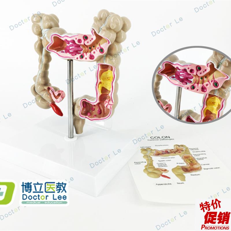 正品人体结c肠病变模型肛肠科消化科大肠模型医用人体解剖肠道模