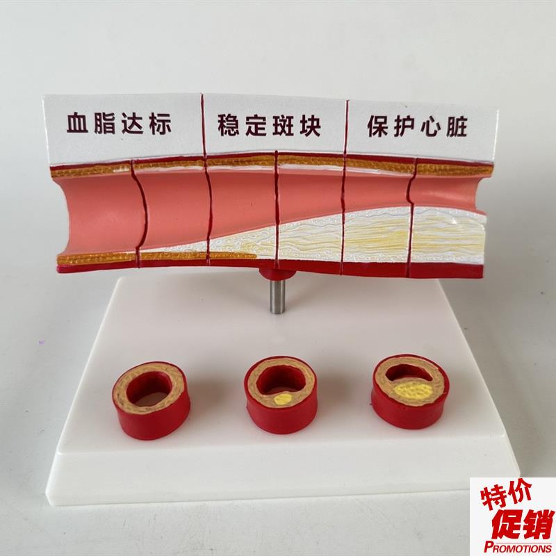 血管/堵b塞动支脉粥样/硬化心血管动脉/硬化模型血管病理模型血栓