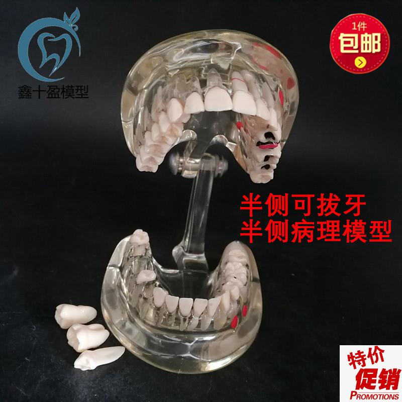牙科牙齿模型成人病理半侧可拔牙模型医患沟通口T腔教学教具C3