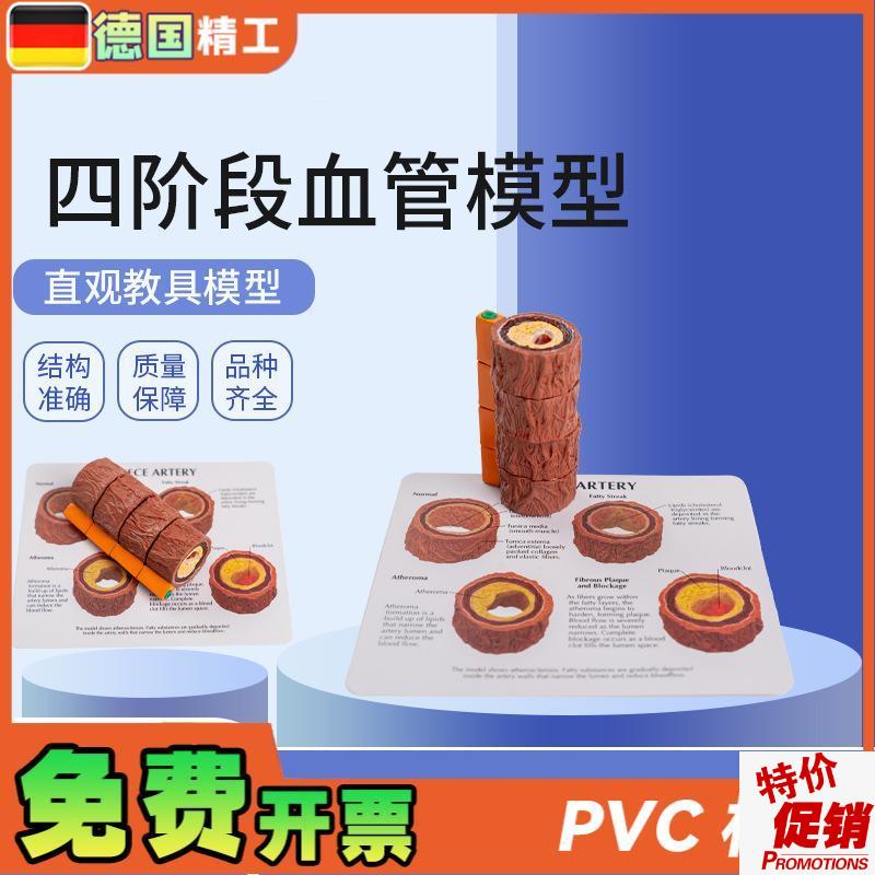德国】血管模型人体四阶段血管标本心G内科医患沟通演示血管硬化